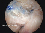 Arthroskopie hinteres Kreuzband